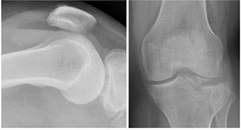 X Knee Startradiology Knee Radiology Imaging Knee Joint