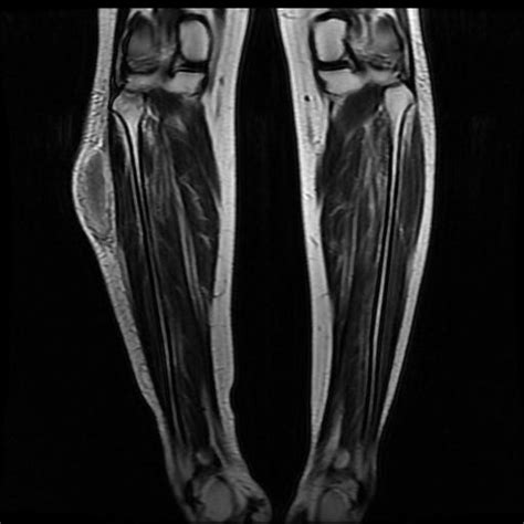 Subcutaneous Hematoma Leg Mri Image