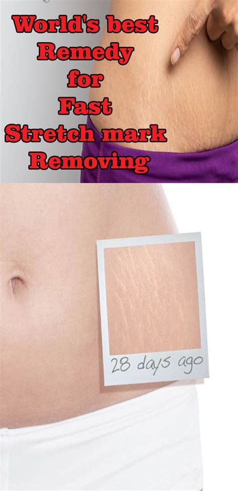 They are the bags that fall on the cheeks, below the lower eyelids, that make you look like you haven't slept for weeks. How To Get Rid Of Stretch Marks Naturally - Remove Stretch ...