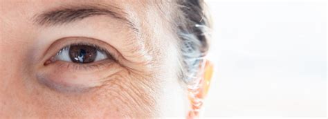 Premature Aging Signs Symptoms And Prevention