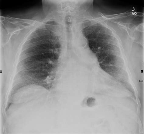 141lu Fibrotic Nsip Possible Lungs