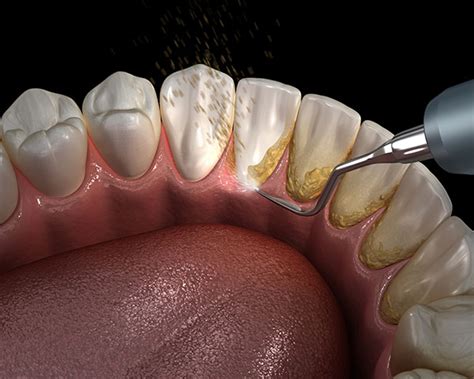 Risk factors & symptoms of periodontal disease. Gum Disease Treatment | Dentist | Plantation, FL | Atlas ...