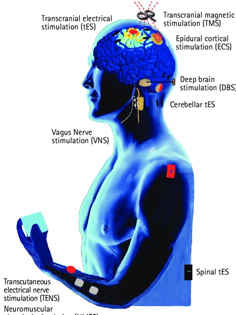 Typical Electrical Stimulation Modalities For Post Stroke Motor