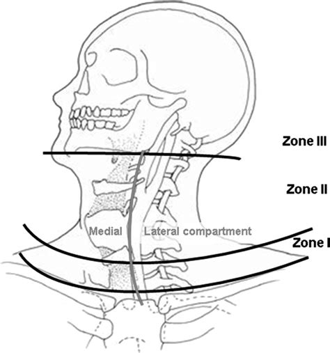 Systematization Of The Neck Into Three Anatomical Zones I Ii And