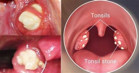 How To Get Rid Of White Spots On Tonsils Jack Wu Media