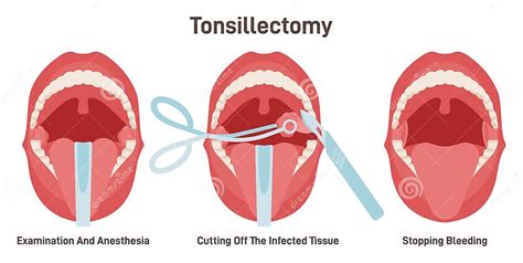 Tonsillectomy Acute Pharyngitis Treatment Surgical Removal Of The