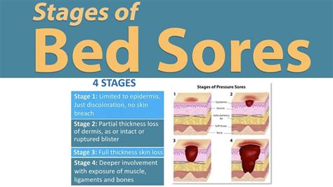 Stages Of Bed Sores Pressure Sores Youtube