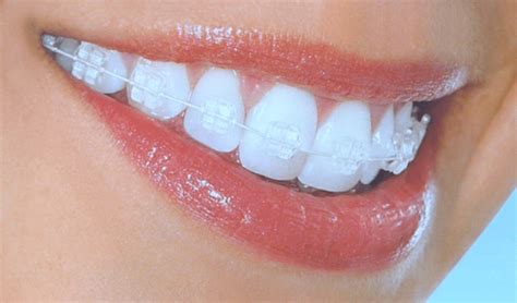 Clear Braces A Perfect Smile Orthodontics