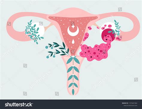 women health floral infographic ovarian cyst stock vector royalty free 1737681584