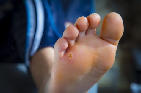 Foot Callus And Corn Treatment Everything You Need To Know Nicershoes