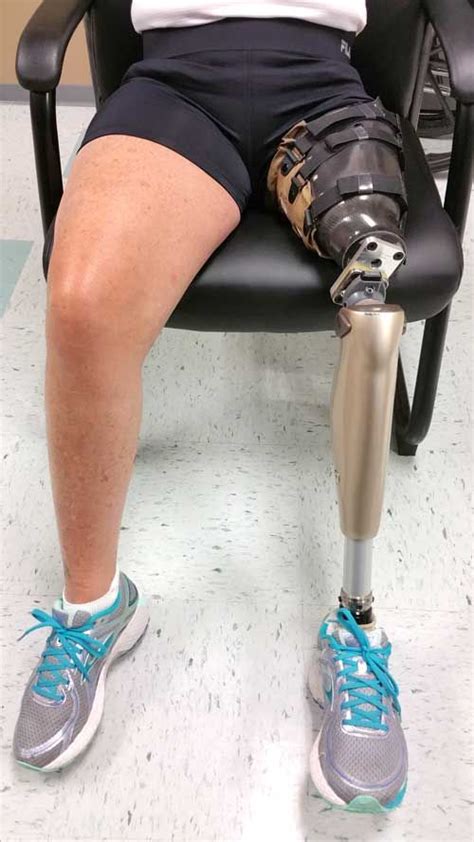 Mary Prosthetic Leg Prosthetics Workout Apps