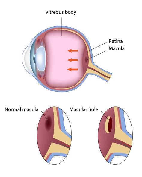 Picture Of Macular Hole Vmr Institute Huntington Beach Ca 92647