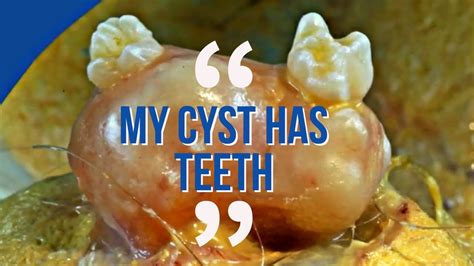 Is This A Record Breaking Dermoid Cyst Dermoid Cysts Case Study Cyst Grows Hair And Teeth