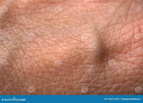 Hand Skin With Swollen Veins Stock Photo Image Of Injury Body 142211318