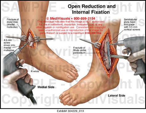 Medivisuals Open Reduction And Internal Fixation Medical Illustration