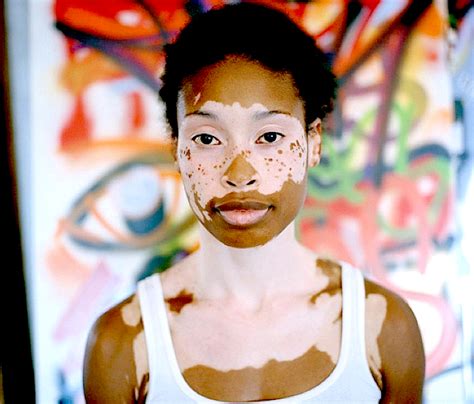 Vitiligo Anatomybox