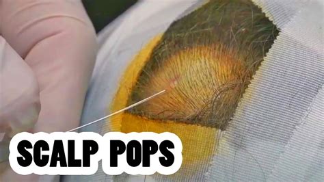 Biggest Scalp Cysts Pilar Cysts And Incredible Pops Dr John Gilmore