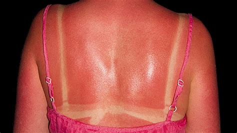 Learn how to treat common sunburns and when to seek medical treatment. The Best Sunburn Treatments | Things Health