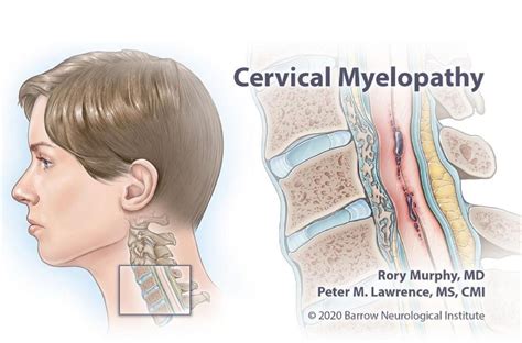 Cervical Myelopathy Symptoms Causes And Treatment Progressive Care