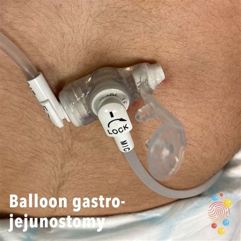 Gastrostomy Skin Deep