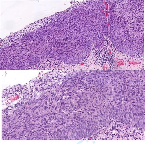 Vaginal Carcinoma After Cervical Dysplasia International Journal Of Gynecologic Cancer