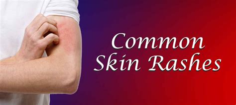 Skin Rash Causes And Treatment