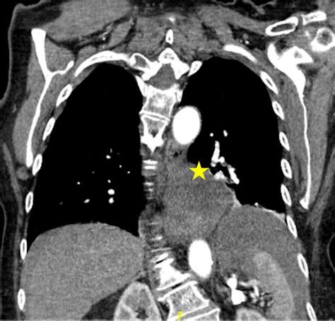Cureus Acute Gastric Volvulus In The Setting Of A Paraesophageal