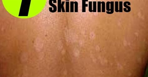 7 Home Remedies For Skin Fungus Home Remedies Pinterest Remedies