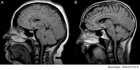 Clinical And Magnetic Resonance Imaging Abnormalities Of The Tongue In
