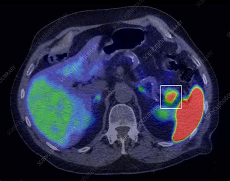 Pancreatic Cancer Ct And Pet Scans Stock Image C0515762 Science