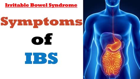 Signs And Symptoms Of Irritable Bowel Syndrome Ask Eric Bakker Youtube
