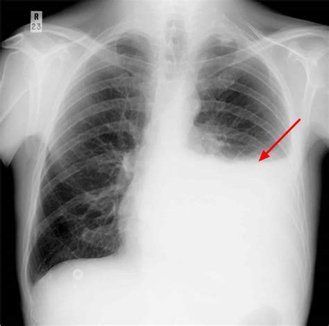 Obliteration of left costophrenic angle with a wide pleural based dome shaped opacity projecting into the lung noted tracking along the cp angle and lateral chest wall. Pleural effusion causes, types, symptoms, diagnosis and ...