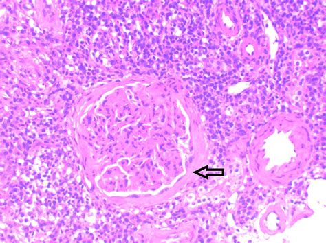 Cureus Igg4 Related Disease With Renal And Pulmonary Involvement