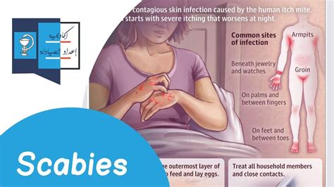 Scabies Diagnosis And Treatment Youtube