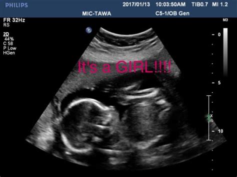 20 Week Ultrasound June 2017 Babycenter Canada