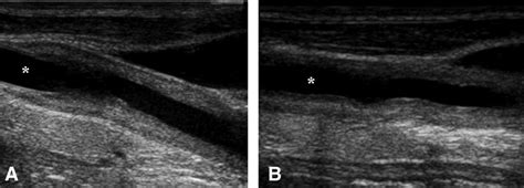 B Mode Ultrasound Of The Carotid Arteries Shows Long Smooth