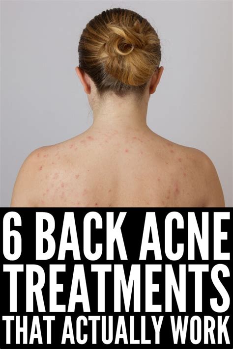 How To Get Rid Of Back Acne 11 Tips And Remedies That Work Back Acne
