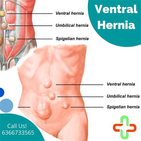 Hernia Incisional Dr Hernias Hot Sex Picture