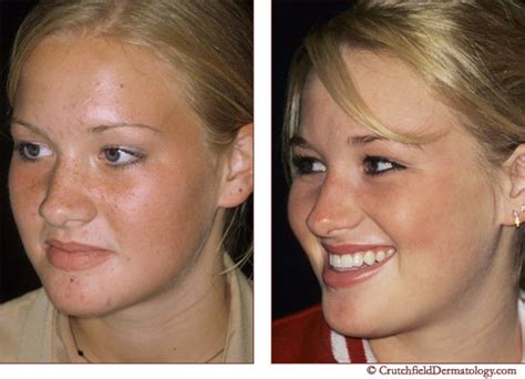 Acne Before And After Acne 0603
