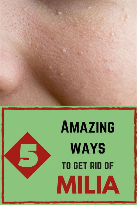 How To Get Rid Of Milia 5 Amazing Home Remedies Skin Care Tips