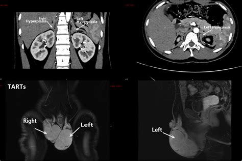 Bilateral Adrenal Hyperplasia Showed In Enhanced Computed Download