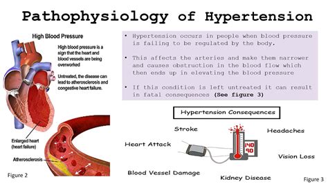 Hypertension Ppt Youtube