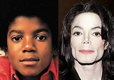 How Michael Jackson struggled with vitiligo and turned white ...