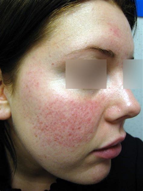 Flushing And Facial Redness Rosacea Types Arsc