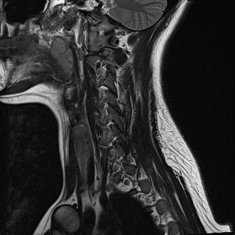 Normal Trauma Cervical Spine Mri Radiology Case Radiopaedia Org