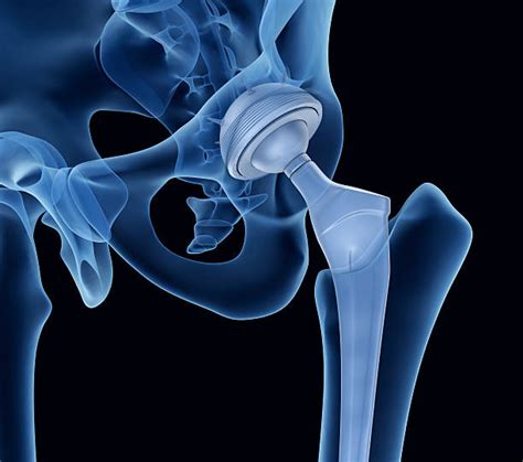 Orthopedics Stock Photos Pictures And Royalty Free Images Istock