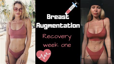 My Breast Augmentation Experience Honest Youtube