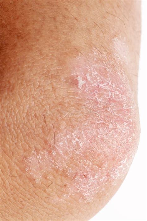 Psoriasis Bumps On Elbows