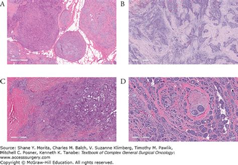 Tumors Of The Salivary Glands Oncohema Key