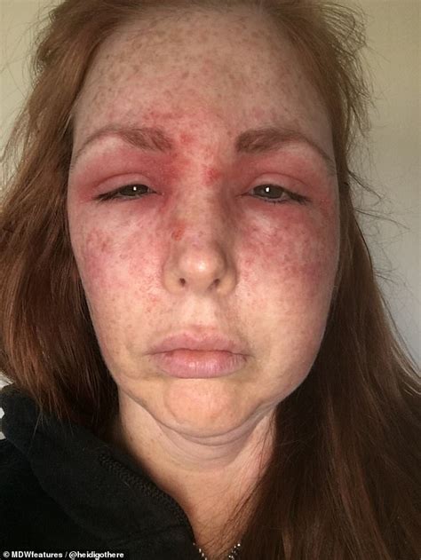Woman 42 Wakes Up With A Black Eye And Swollen Face After Being
